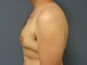 Gynecomastia Before and After Pictures Nashville, TN