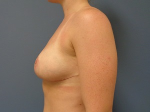 Breast Reduction Before and After Pictures Nashville, TN