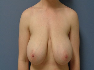 Breast Reduction Before and After Pictures Nashville, TN