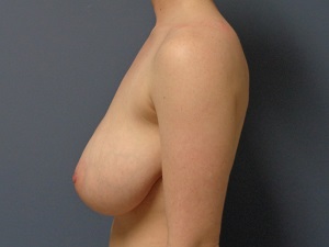 Breast Reduction Before and After Pictures Nashville, TN