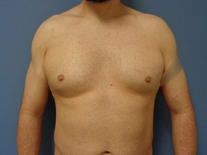 Gynecomastia Before and After Pictures Nashville, TN