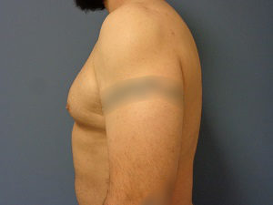 Gynecomastia Before and After Pictures Nashville, TN