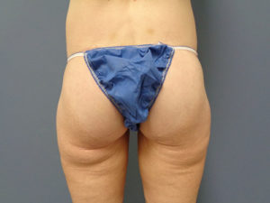 Butt Augmentation Before and After Pictures Nashville, TN