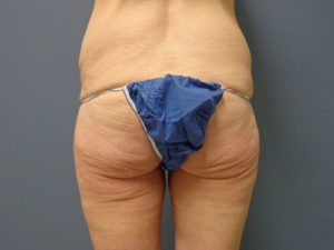 Butt Augmentation Before and After Pictures Nashville, TN