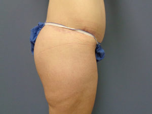 Butt Augmentation Before and After Pictures Nashville, TN