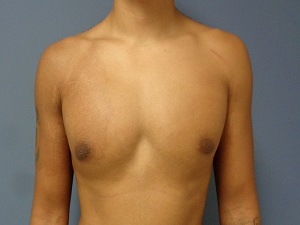 Gynecomastia Before and After Pictures Nashville, TN