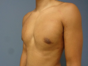 Gynecomastia Before and After Pictures Nashville, TN