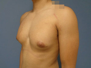 Gynecomastia - Patient Before & After Pictures in Nashville, TN