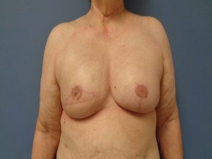 Breast Reconstruction Before and After Pictures Nashville, TN