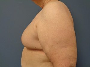 Breast Reconstruction Before and After Pictures Nashville, TN