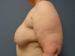 Breast Reconstruction Before and After Pictures Nashville, TN