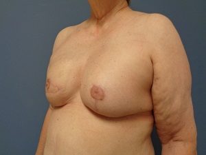 Breast Reconstruction Before and After Pictures Nashville, TN