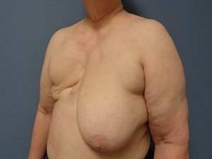 Breast Reconstruction Before and After Pictures Nashville, TN