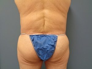 Body Lift Before and After Pictures Nashville, TN