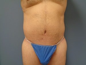 Body Lift Before and After Pictures Nashville, TN