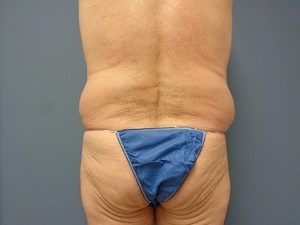 Body Lift Before and After Pictures Nashville, TN