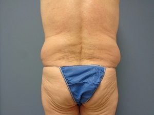 Body Lift Before and After Pictures Gallery Nashville, Franklin, TN