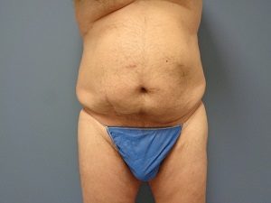 Body Lift Before and After Pictures Nashville, TN
