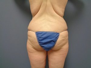 Butt Augmentation Before and After Pictures Nashville, TN