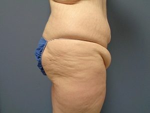 Butt Augmentation Before and After Pictures Nashville, TN