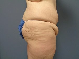 Butt Augmentation Before and After Pictures Nashville, TN
