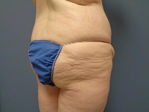 Butt Augmentation Before and After Pictures Nashville, TN