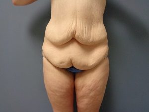 Body Lift Before and After Pictures Nashville, TN