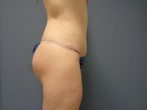 Butt Augmentation Before and After Pictures Nashville, TN