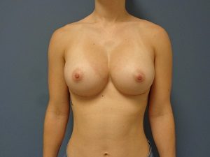 Breast Augmentation Before and After Pictures Nashville, TN