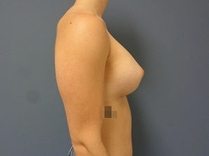 Breast Augmentation Before & After Pictures in Nashville, TN