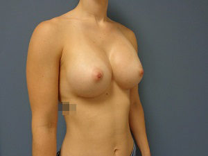 Breast Augmentation Before & After Pictures in Nashville, TN