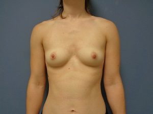 Breast Augmentation Before and After Pictures Nashville, TN