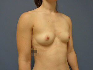 Breast Augmentation Before & After Pictures in Nashville, TN