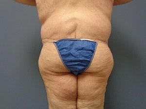 Body Lift Before and After Pictures Nashville, TN