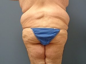 Body Lift Before and After Pictures Nashville, TN