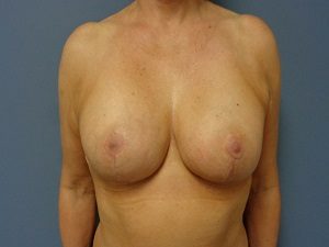 Breast Reduction Before and After Pictures Nashville, TN