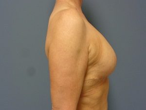 Breast Reduction Before and After Pictures Nashville, TN