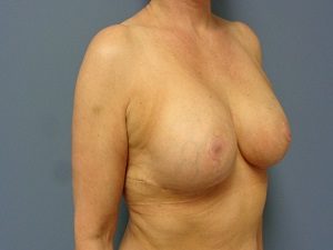 Breast Reduction Before and After Pictures Nashville, TN