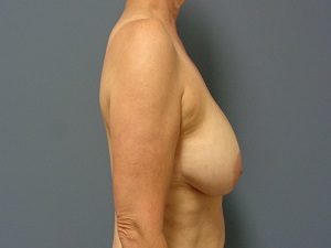 Breast Reduction Before and After Pictures Nashville, TN