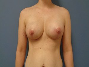 Breast Augmentation Before and After Pictures Nashville, TN