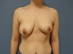 Breast Augmentation Before and After Pictures Nashville, TN