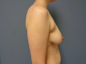 Breast Augmentation Before and After Pictures Nashville, TN