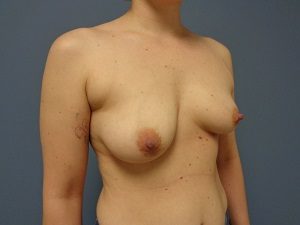 Breast Augmentation Before and After Pictures Nashville, TN