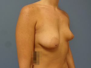 Breast Augmentation with Lift Before & After Pictures in Nashville, TN