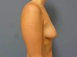 Breast Augmentation with Lift Before & After Pictures in Nashville, TN