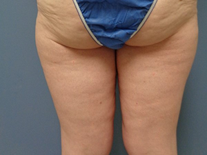 Thigh Lift Before and After Pictures Nashville, TN