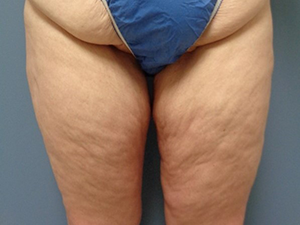 Thigh Lift Before and After Pictures Nashville, TN