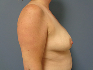 Breast Augmentation Before and After Pictures Nashville, TN