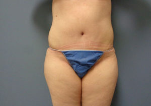 Tummy Tuck Before and After Pictures Nashville, TN