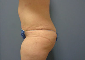 Tummy Tuck Before and After Pictures Nashville, TN